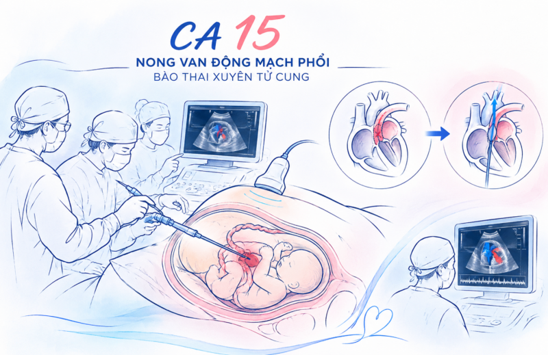 TP.HCM can thiệp tim bào thai 26 tuần, mở cơ hội phát triển lại thất phải